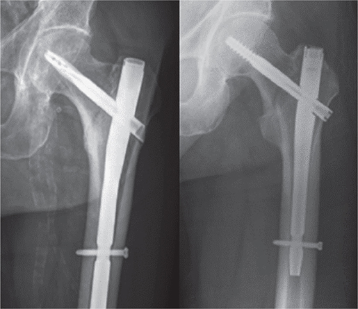 increased-failure-rates-after-the-introduction-of-the-tfna-proximal-femoral-nail-for