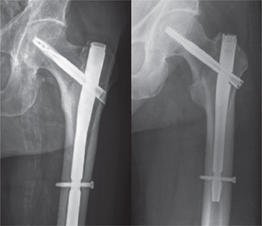 Increased Failure Rates After The Introduction Of The TFNA Proximal 