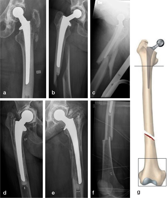 Fracture pattern and risk factors for reoperation after treatment of ...