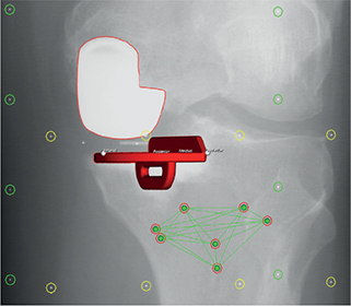 Preoperative proximal tibial bone density, bone microarchitecture, and ...
