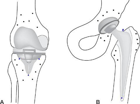 Guideline for RSA and CT-RSA implant migration measurements: an update ...
