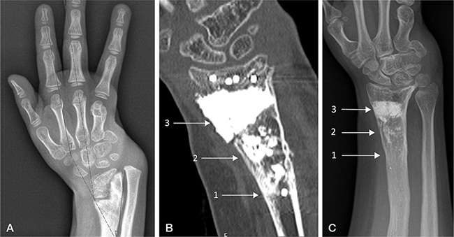 Calcium phosphate bone cement and metaphyseal corrective osteotomies in ...